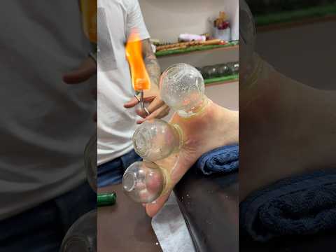wow nice cupping😍❤️#cupping #shorts #cuppingtherapy #explore
