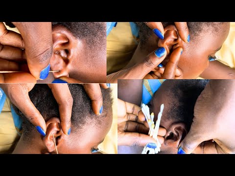 Asmr ✨A Rare And Attentive Ear Cleaning -Tingles