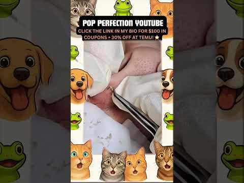 Wow! #pimpleremoval #pimple #pimples #shortsfeed #shortvideo #shorts #short #youtube #youtubeshorts