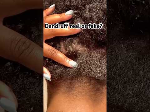 Dandruff real or fake? #relaxing #scratching #brushing #fypシ゚viral #shortsvideo #dandruff