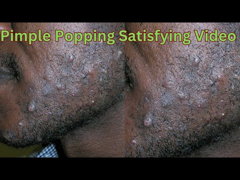 Asmr Pimples popping  satisfying videos Blackheads. #asmr #nitpicking #satisfying #oddlysatisfying
