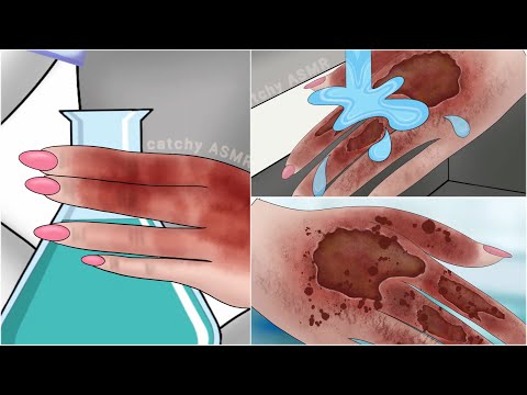 Chemical burn hand treatment animation || skin repair ASMR animation ||