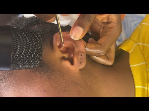 ASMR COME LET ME MAKE CLEAN YOUR EARS AND NITPICKING IT FOR A VERY SWEET SLEEP WITH GUM