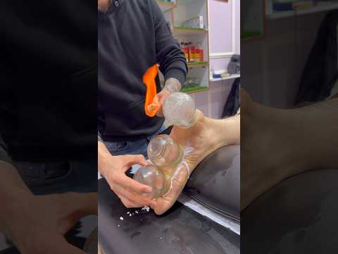 "ASMR" vip cupping alinezhad #cupping #asmr #shorts #trending #explore
