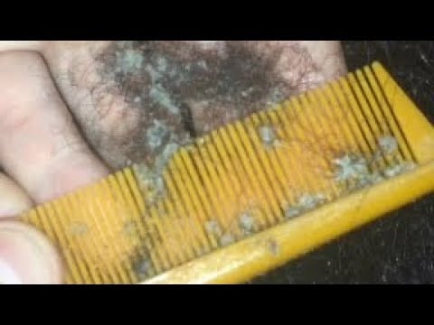 [ASMR] SCRATCHING VERY DRY & BIG DANDRUFF FLAKES from scalp after unbraiding 4C HAIR [HD]