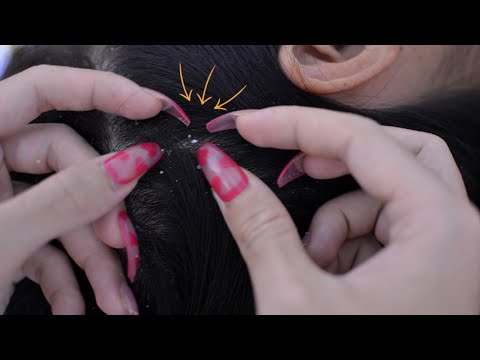 ASMR Scalp Check Dandruff With Long Nails Relaxing For Sleep ( No Talking )