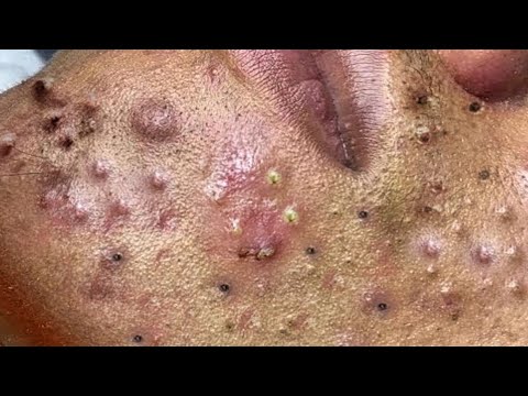 حلول طبيعية لبشرة صافية# 𝐒𝐤𝐢𝐧 𝐂𝐚𝐫𝐞 99555