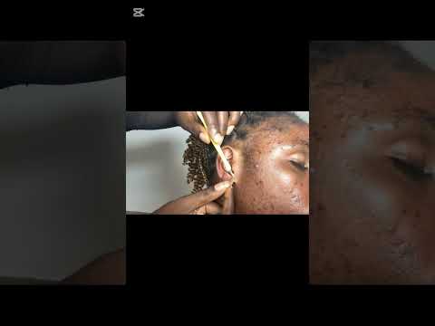 ASMR SATISFYING NITPICKING AND EAR CLEANING FOR DEEP SLEEP, VERY SATISFYING