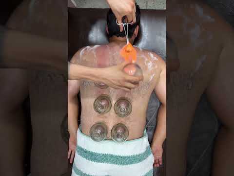 wow nice cupping😍❤️#viral #shorts #cupping #asmr #youtubeshorts