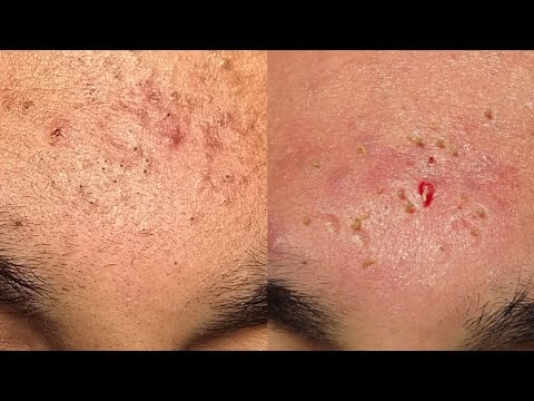 ASMR BLACK SPOTS ACNE CLEANING / SKIN CARE ( NO ADVERTISING)