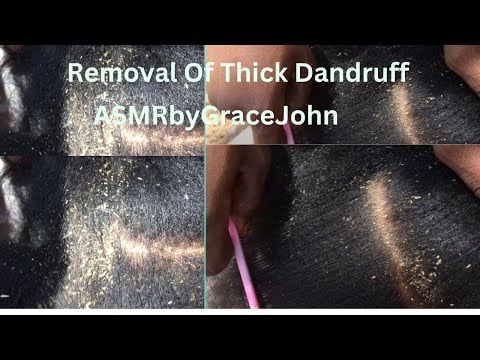 Asmr Thick Dandruff removal on my Afro hair. #dandruff #asmr #amsrtriggers