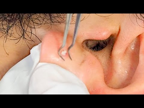 ASMR So Tingly Ear Picking, Cleaning & Massaging 😬 😴