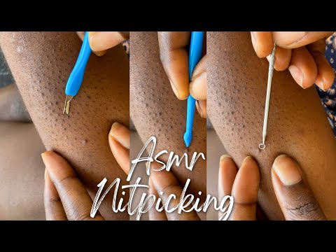 ✨Asmr✨ Nitpicking Blackheads- Gum chewing, Rain sounds
