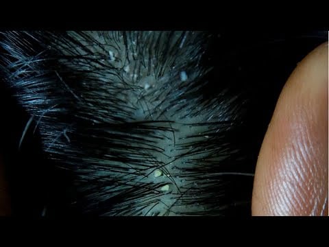 {ASMR} Full Head Scalp check up | Nitpicking whiteheads Slow & intense.