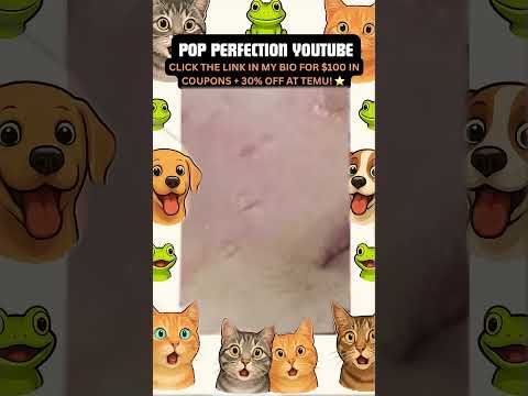 Wow! #pimpleremoval #pimple #pimples #shortsfeed #shortvideo #shorts #short #youtube #youtubeshorts