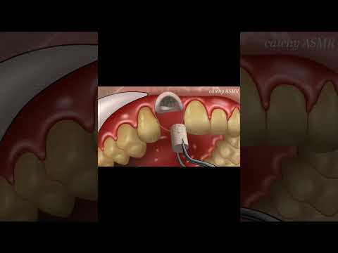 Bone grafting on tooth animation || ASMR animation #treatmentanimation #2d  #stopmotion #animation