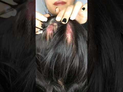 ASMR Dry Scalp Removal 💆🏻‍♀️ #asmr #asmrhairplay #relax #asmrhaircare #shorts #satisfying #tingles