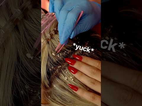 Satisfying DANDRUFF Removal ASMR  #asmr