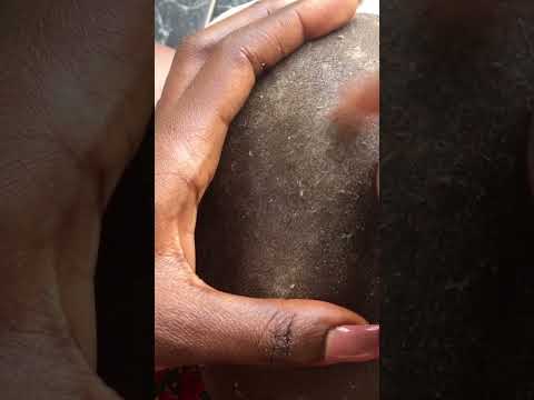 Dandruff Removal on a bald hair #tingling #satisfying #lice #relaxing #nitpicking #dandruff