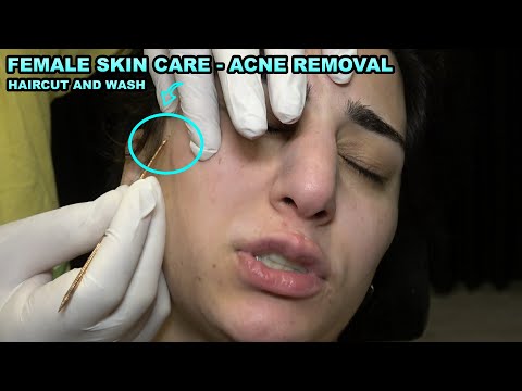 ASMR FEMALE SKIN ACNE REMOVAL AND CARE + HAIRCUT + HAIR CARE + HAIR WASH +  DEEP SLEEP FOR YOU