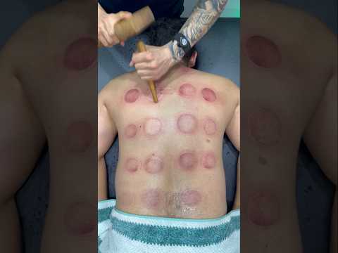 cuppingtherapy ❤️‍🔥#shorts #explore #massage #cupping #asmr #viral