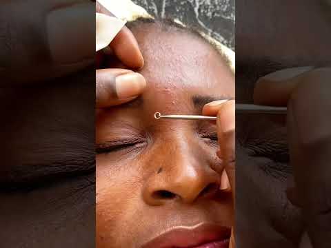 Asmr face Nitpicking #asmr # #pimplepopper #blackheadsremoval #earcleaning