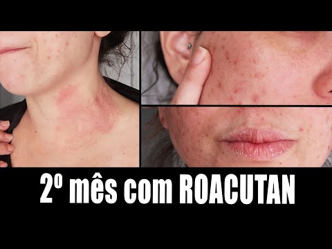 Diário Roacutan: 2ºmes!