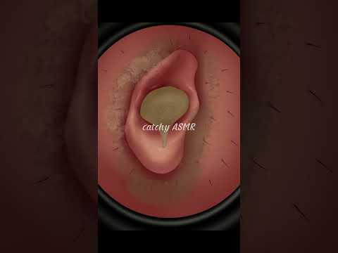 Relaxing ASMR Ear wax removal Animation, ear wax water treatment #asmr #animation #trending #earwax