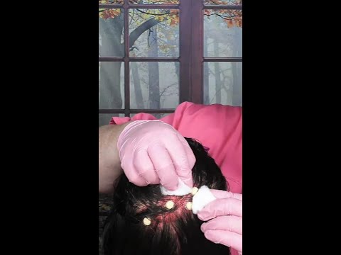 ASMR Acne Removal (Pimple Popping) #shorts