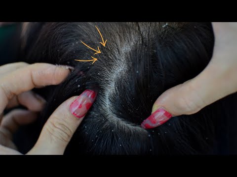 ASMR Scalp Check With Long Nails Relaxing For Rest And Sleep ( No Talking )