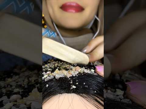 Dandruff Removal 😱💆🏻‍♀️ #asmr #satisfying #visualtingle #shorts  #scratching #asmrscalpscratching