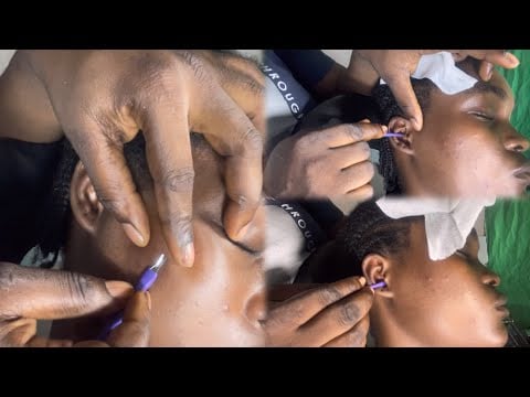 ASMR✨SATISFYING EAR CLEANING, FACE AND EAR NITPICKING, WITH GUM CRACKING SOUND.    T✨R✨I✨G✨G✨E✨R✨S.