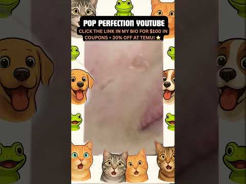 Wow! #pimpleremoval #pimple #pimples #shortsfeed #shortvideo #shorts #short #youtube #youtubeshorts