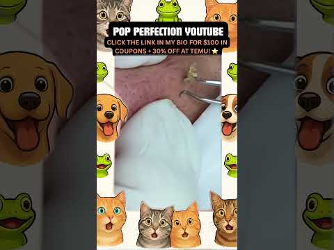 Wow! #pimpleremoval #pimple #pimples #shortsfeed #shortvideo #shorts #short #youtube #youtubeshorts