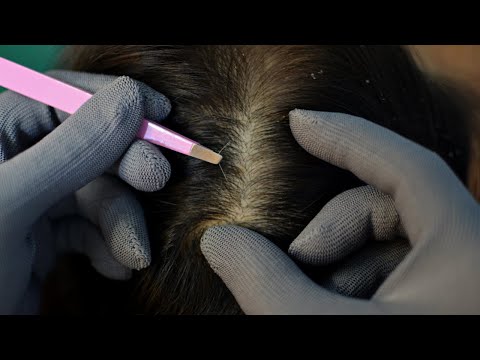 ASMR Scalp Check Using Gloves & Tweezers Relaxing For Sleep ( No Talking )