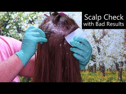ASMR Scalp Check with Bad Results (Dandruff Removal, Scalp Treatment, Whispering) Medical Roleplay