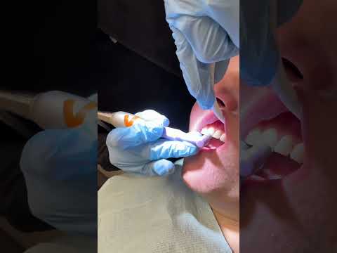 ASMR Teeth Cleaning 😬 Scraping, Suction & Plaque Removal Sounds #asmrsounds #asmrdentist #teeth