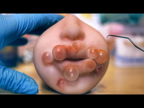 ASMR CUIDANDO DA SUA HERPES - Sweet Carol