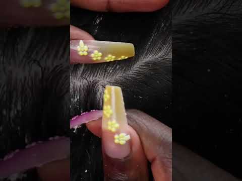 Satisfying Dandruff scratchin removal #youtubeshorts #shorts #asmr #asmrsounds #satisfying #explore