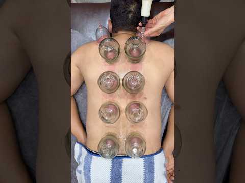 wow vip cupping alinezhad😍❤️#cupping #shorts #asmr #viral