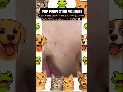 Wow! #pimpleremoval #pimple #pimples #shortsfeed #shortvideo #shorts #short #youtube #youtubeshorts