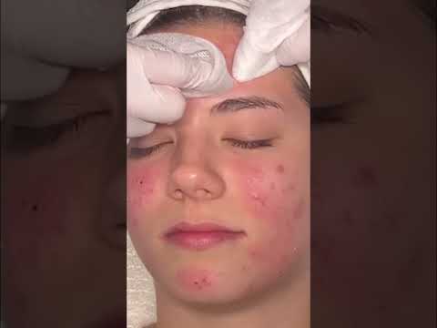 Zap Cystic Pimples FAST with High Frequency Wand! #shorts