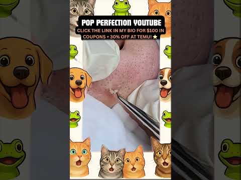 Wow! #pimpleremoval #pimple #pimples #shortsfeed #shortvideo #shorts #short #youtube #youtubeshorts