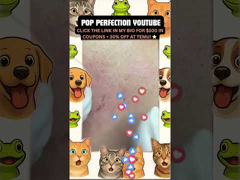 Wow! #pimpleremoval #pimple #pimples #shortsfeed #shortvideo #shorts #short #youtube #youtubeshorts