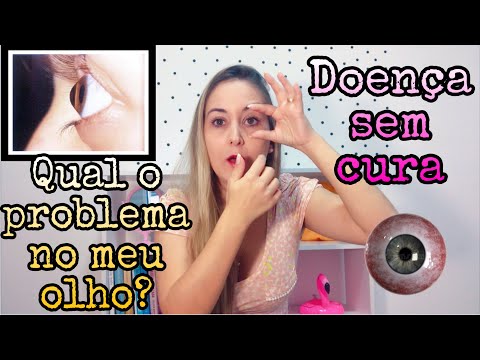 TUDO SOBRE CERATOCONE E A CIRURGIA “CROSSLINKING” - DOENÇA GRAVE NOS OLHOS | Bianca Peres
