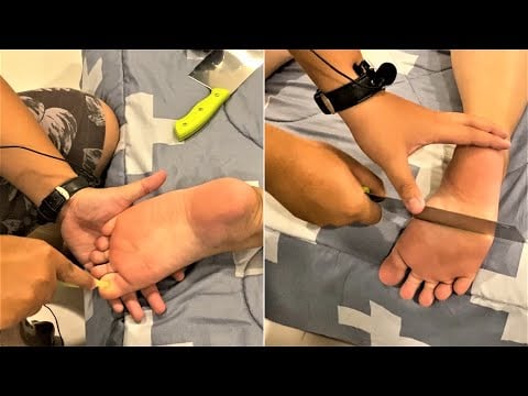 ASMR Powerful Foot Massage with Tools and Knife- Relaxing Massage by Pherak