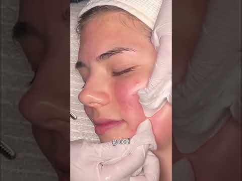 Pimple Popping Confessions: Do You Dare to Pop? #shorts