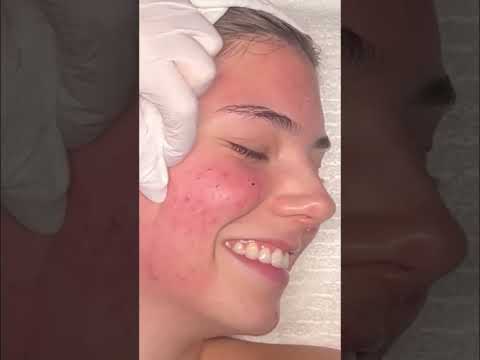Satisfying Pimple Popping: Names, Sizes, and 'Good Stuff'! #shorts