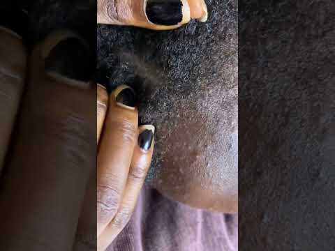 Asmr dandruff Scratches & Nits picking