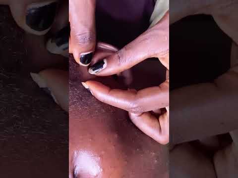 Preauricular pit Nitpicking #relax #asmr #satisfying